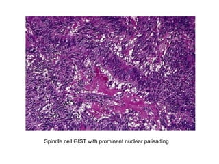 Spindle cell GIST with prominent nuclear palisading
 