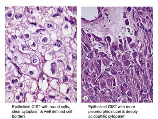 Epithelioid GIST with more
pleomorphic nuclei & deeply
acidophilic cytoplasm
Epithelioid GIST with round cells,
clear cytoplasm & well defined cell
borders
 