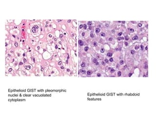 Epithelioid GIST with pleomorphic
nuclei & clear vacuolated
cytoplasm
Epithelioid GIST with rhabdoid
features
 
