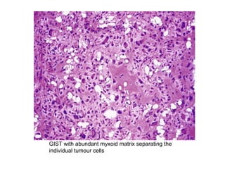 GIST with abundant myxoid matrix separating the
individual tumour cells
 