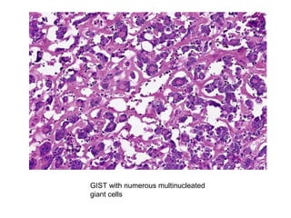 GIST with numerous multinucleated
giant cells
 