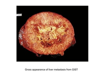 Gross appearance of liver metastasis from GIST
 