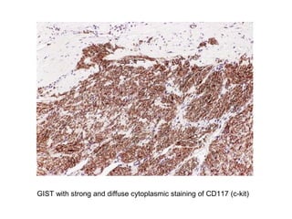 GIST with strong and diffuse cytoplasmic staining of CD117 (c-kit)
 