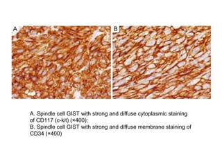 A. Spindle cell GIST with strong and diffuse cytoplasmic staining
of CD117 (c-kit) (×400);
B. Spindle cell GIST with strong and diffuse membrane staining of
CD34 (×400)
 