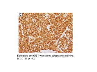 Epithelioid cell GIST with strong cytoplasmic staining
of CD117 (×100)
 