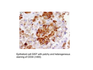 Epithelioid cell GIST with patchy and heterogeneous
staining of CD34 (×400)
 