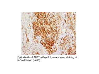 Epithelioid cell GIST with patchy mambrane staining of
h-Caldesmon (×400)
 
