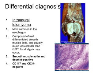 Differential diagnosis
• Intramural
leiomyoma
1. Most common in the
esophagus
2. Composed of well
differentiated smooth
muscle cells, and usually
much less cellular than
GIST; focal atypia may
occur.
3. Smooth muscle actin and
desmin-positive
4. CD117 and CD34-
negative
 