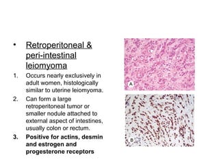 • Retroperitoneal &
peri-intestinal
leiomyoma
1. Occurs nearly exclusively in
adult women, histologically
similar to uterine leiomyoma.
2. Can form a large
retroperitoneal tumor or
smaller nodule attached to
external aspect of intestines,
usually colon or rectum.
3. Positive for actins, desmin
and estrogen and
progesterone receptors
 