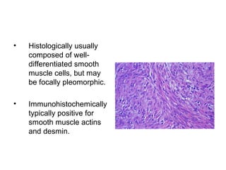 • Histologically usually
composed of well-
differentiated smooth
muscle cells, but may
be focally pleomorphic.
• Immunohistochemically
typically positive for
smooth muscle actins
and desmin.
 