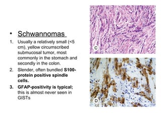 • Schwannomas
1. Usually a relatively small (<5
cm), yellow circumscribed
submucosal tumor, most
commonly in the stomach and
secondly in the colon.
2. Slender, often bundled S100-
protein positive spindle
cells.
3. GFAP-positivity is typical;
this is almost never seen in
GISTs
 