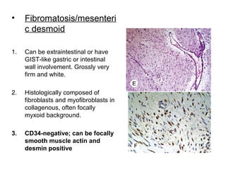 • Fibromatosis/mesenteri
c desmoid
1. Can be extraintestinal or have
GIST-like gastric or intestinal
wall involvement. Grossly very
firm and white.
2. Histologically composed of
fibroblasts and myofibroblasts in
collagenous, often focally
myxoid background.
3. CD34-negative; can be focally
smooth muscle actin and
desmin positive
 