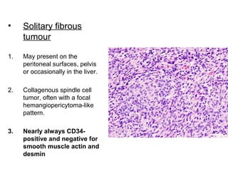 • Solitary fibrous
tumour
1. May present on the
peritoneal surfaces, pelvis
or occasionally in the liver.
2. Collagenous spindle cell
tumor, often with a focal
hemangiopericytoma-like
pattern.
3. Nearly always CD34-
positive and negative for
smooth muscle actin and
desmin
 