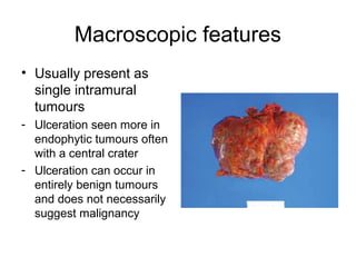 Macroscopic features
• Usually present as
single intramural
tumours
- Ulceration seen more in
endophytic tumours often
with a central crater
- Ulceration can occur in
entirely benign tumours
and does not necessarily
suggest malignancy
 