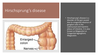 Hirschsprung’s disease
• Hirschsprung’s disease is a
disorder of the gut caused
due to congenital absence of
ganglion cells in the
submucosal and myentric
plexus of intestine. It is also
known as Megacolon or
Congenital Aganglionic
Megacolon.
 