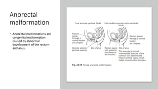 Anorectal
malformation
• Anorectal malformations are
congenital malformation
caused by abnormal
development of the rectum
and anus.
 