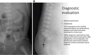 Diagnostic
evaluation
• Physical examination
• Cystoscopy
• An IV pyelogram and a voiding
cystourethrogram are performed to
evaluate associated anomalies
involving the urinary tract.
• Other diagnostic examinations that
may be performed include pelvic MRI,
radiography, ultrasonography, and
fluoroscopic examination of pelvic
anatomic contents and lower spinal
anatomy.
 