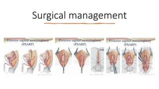 Surgical management
 