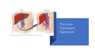 The Liver
Transplant
Operation
 