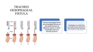 TRACHEO
OESOPHAGEAL
FISTULA
Tracheo-esophageal fistula
and esophageal Atresia are
the malformations of
digestive system, in which
esophagus does not
develop properly.
Esophagus is a tube that
normally carries food from
the mouth to the stomach
 