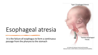 Esophageal atresia
It is the failure of esophagus to form a continuous
passage from the pharynx to the stomach
 