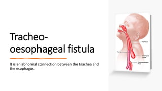 Tracheo-
oesophageal fistula
It is an abnormal connection between the trachea and
the esophagus.
 