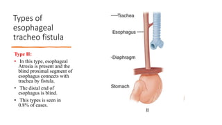 Types of
esophageal
tracheo fistula
Type II:
• In this type, esophageal
Atresia is present and the
blind proximal segment of
esophagus connects with
trachea by fistula.
• The distal end of
esophagus is blind.
• This types is seen in
0.8% of cases.
 