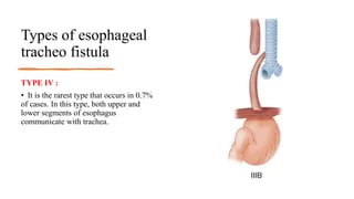 Types of esophageal
tracheo fistula
TYPE IV :
• It is the rarest type that occurs in 0.7%
of cases. In this type, both upper and
lower segments of esophagus
communicate with trachea.
 