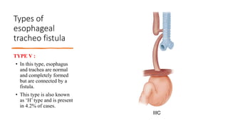 Types of
esophageal
tracheo fistula
TYPE V :
• In this type, esophagus
and trachea are normal
and completely formed
but are connected by a
fistula.
• This type is also known
as ‘H’ type and is present
in 4.2% of cases.
 