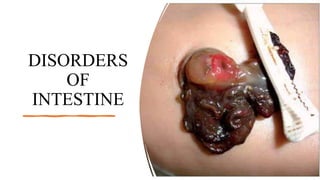 DISORDERS
OF
INTESTINE
 