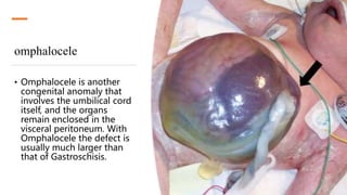 omphalocele
• Omphalocele is another
congenital anomaly that
involves the umbilical cord
itself, and the organs
remain enclosed in the
visceral peritoneum. With
Omphalocele the defect is
usually much larger than
that of Gastroschisis.
 