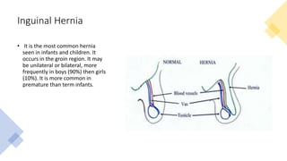 Inguinal Hernia
• It is the most common hernia
seen in infants and children. It
occurs in the groin region. It may
be unilateral or bilateral, more
frequently in boys (90%) then girls
(10%). It is more common in
premature than term infants.
 