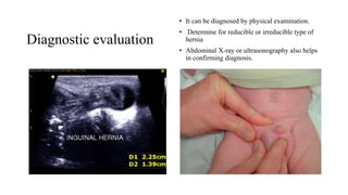 Diagnostic evaluation
• It can be diagnosed by physical examination.
• Determine for reducible or irreducible type of
hernia
• Abdominal X-ray or ultrasonography also helps
in confirming diagnosis.
 