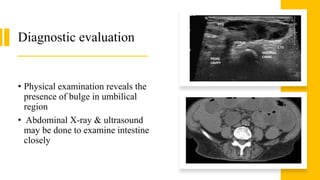 Diagnostic evaluation
• Physical examination reveals the
presence of bulge in umbilical
region
• Abdominal X-ray & ultrasound
may be done to examine intestine
closely
 