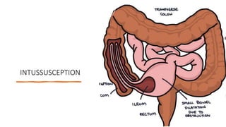 INTUSSUSCEPTION
 