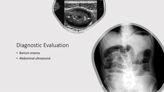 Diagnostic Evaluation
• Barium enema
• Abdominal ultrasound
 
