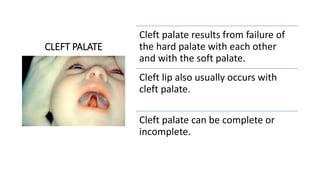 CLEFT PALATE
Cleft palate results from failure of
the hard palate with each other
and with the soft palate.
Cleft lip also usually occurs with
cleft palate.
Cleft palate can be complete or
incomplete.
 