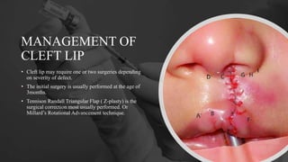 MANAGEMENT OF
CLEFT LIP
• Cleft lip may require one or two surgeries depending
on severity of defect.
• The initial surgery is usually performed at the age of
3months.
• Tennison Randall Triangular Flap ( Z-plasty) is the
surgical correction most usually performed. Or
Millard’s Rotational Advancement technique.
 