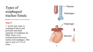 Types of
esophageal
tracheo fistula
Type I:
• In this type, there is
esophageal atresia and
proximal and distal
segments of esophagus are
blind. There is no
communication between
trachea and esophagus. This
type is seen in 3-7% of
cases.
 