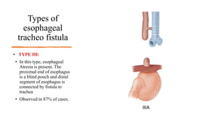 Types of
esophageal
tracheo fistula
• TYPE III:
• In this type, esophageal
Atresia is present. The
proximal end of esophagus
is a blind pouch and distal
segment of esophagus is
connected by fistula to
trachea
• Observed in 87% of cases.
 