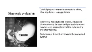 Diagnostic evaluation
Careful physical examination reveals a firm,
olive sized mass in epigastrium
In severely malnourished infants, epigastric
distension may be seen and peristalysis waves
may be seen passing from left to right during
and after feeding
Barium meal X-ray study reveals the narrowed
pylorus
 