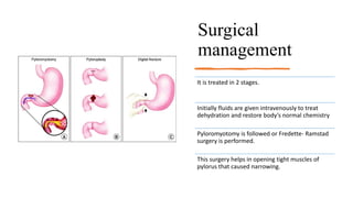 Surgical
management
It is treated in 2 stages.
Initially fluids are given intravenously to treat
dehydration and restore body’s normal chemistry
Pyloromyotomy is followed or Fredette- Ramstad
surgery is performed.
This surgery helps in opening tight muscles of
pylorus that caused narrowing.
 