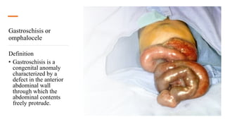 Gastroschisis or
omphalocele
Definition
• Gastroschisis is a
congenital anomaly
characterized by a
defect in the anterior
abdominal wall
through which the
abdominal contents
freely protrude.
 