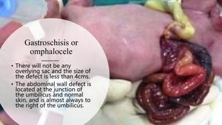 Gastroschisis or
omphalocele
• There will not be any
overlying sac and the size of
the defect is less than 4cms.
• The abdominal wall defect is
located at the junction of
the umbilicus and normal
skin, and is almost always to
the right of the umbilicus.
 