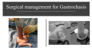 Surgical management for Gastrochasis
 