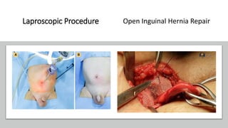 Laproscopic Procedure Open Inguinal Hernia Repair
 