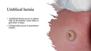 Umblical hernia
• Umbilical hernia occurs in about
10% of all children, more often in
girls than in boys.
• It frequently occurs in premature
infants.
 