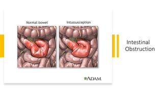 Intestinal
Obstruction
 