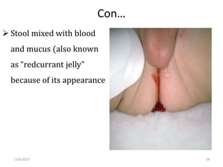Con…
 Stool mixed with blood
and mucus (also known
as “redcurrant jelly"
because of its appearance
28
11/4/2023
 