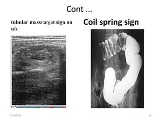Cont ...
tubular mass/target sign on
u/s
Coil spring sign
11/4/2023 30
 